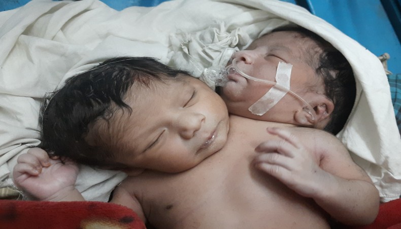 New Age | Two-headed baby taken to Dhaka for treatment